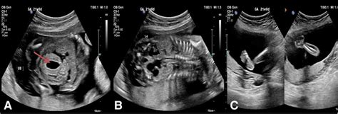 Three images of the first anomaly scan at 21 weeks of gestation in ...