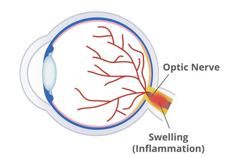 Papilledema (Optic Disc Swelling): Causes Symptoms, 47% OFF