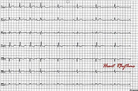 ECG Rhythms: Second degree AV block type I interrupted by nonconducted ...