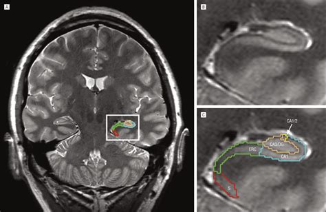 Magnetic Resonance Imaging of Hippocampal Subfields in Posttraumatic Stress Disorder | Neurology ...