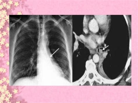 Lung carcinoid tumor