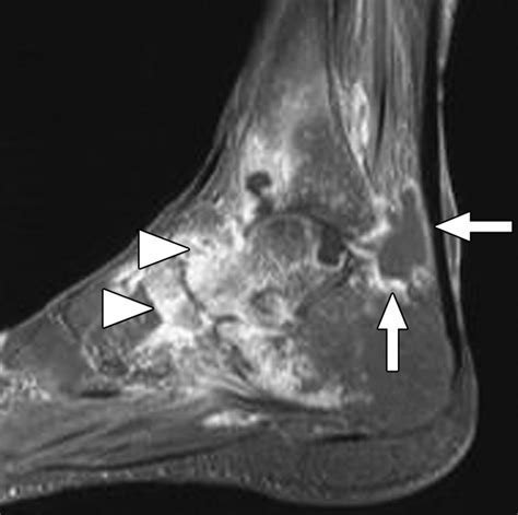 Rheumatoid Arthritis Mri