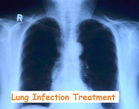 4 Lung Infection Treatment, Definition, Types, And Symptoms