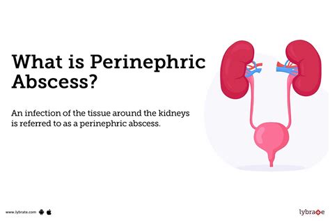 Perinephric Abscess: Causes, Symptoms, Treatment and Cost