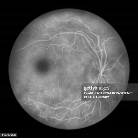 86 Fluorescein Angiography Stock Photos, High-Res Pictures, and Images - Getty Images