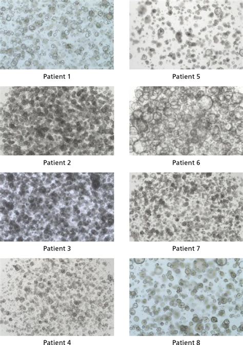 Culturing Intestinal Cancer-Derived Organoids