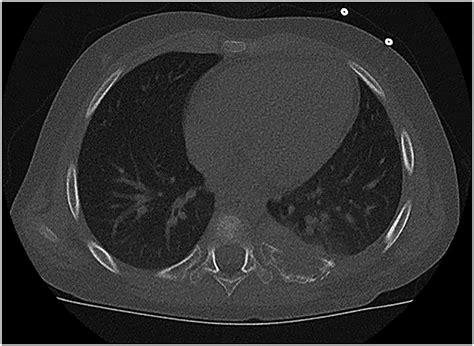 Frontiers | Interdisciplinary Radical “En-Bloc” Resection of Ewing Sarcoma of the Chest Wall and ...