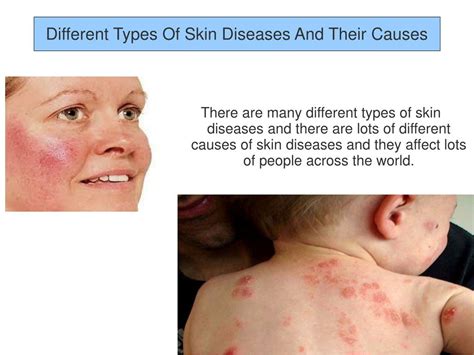 PPT - Different Types Of Skin Diseases And Their Causes PowerPoint ...