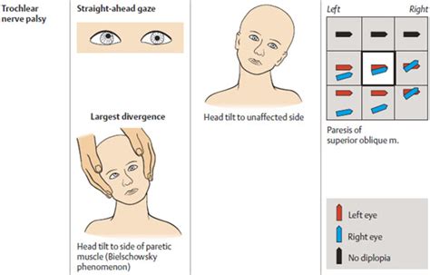 Cranial Nerve Palsy Causes