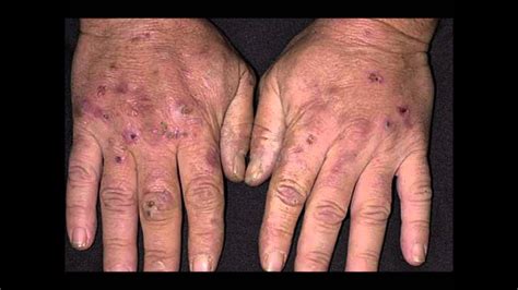 porphyria cutanea tarda useful details - YouTube