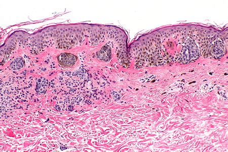 Compound nevus - Libre Pathology