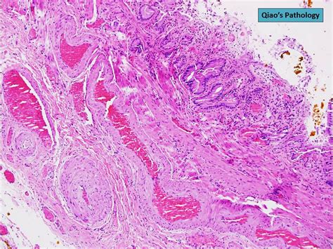 Qiao's Pathology: Angiodysplasia of the Gallbladder - a photo on Flickriver