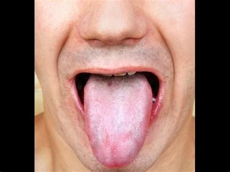 6 Easy Home Remedies to Get Rid of White Coated Tongue - YouTube