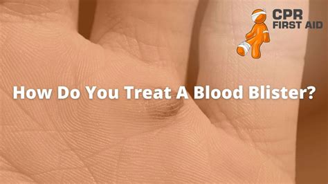 How Do You Treat A Blood Blister? | CPR First Aid