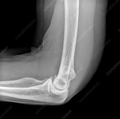 Elbow fracture, X-ray - Stock Image - C038/2440 - Science Photo Library