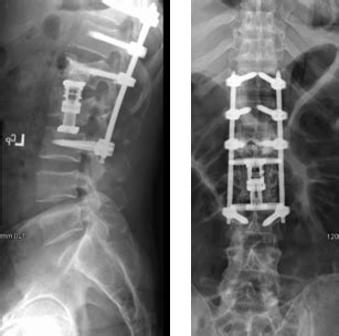 Tapaustutkimus: L1 & L2 Burst Murtumat | The Healthy Spine Blog ...