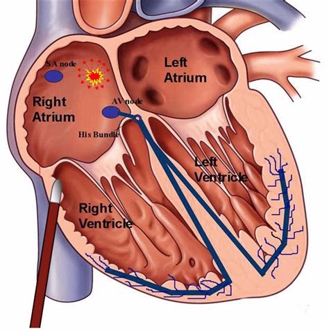 Catheter Ablation for Arrhythmias, Washington DC & Maryland