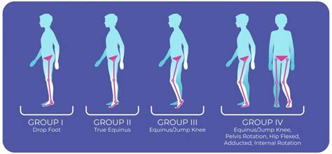 Gait Patterns in Cerebral Palsy Fact Sheet | Cerebral Palsy Foundation