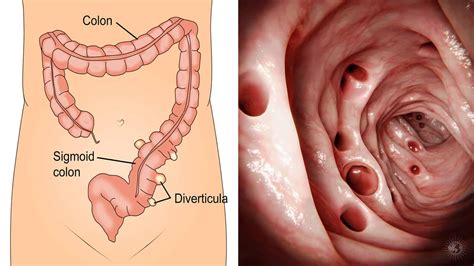 7 Symptoms of Diverticulitis (And Natural Remedies To Help Fix It ...