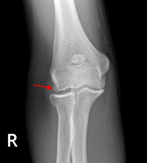 Osteochondritis Dissecans - Causes, Symptoms, Diagnosis & Treatment