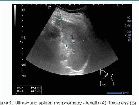 Figure 1 from Ultrasound Criteria of Splenomegaly | Semantic Scholar