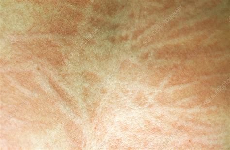 Dermatographic Urticaria - Stock Image - C022/2143 - Science Photo Library