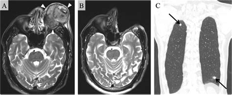 (A) Magnetic resonance imaging (MRI) after chemotherapy. Despite a... | Download Scientific Diagram