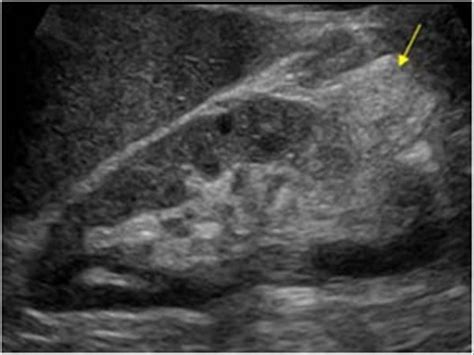 Exophytic angiomyolipoma | Ultrasound sonography, Diagnostic medical ...