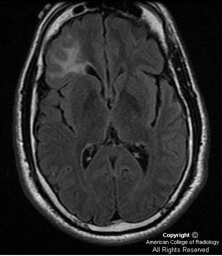 Neuroradiology On the Net: Focal cortical dysplasia