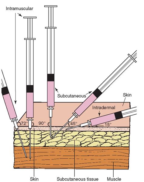 Injection angle + skin layer : r/coolguides