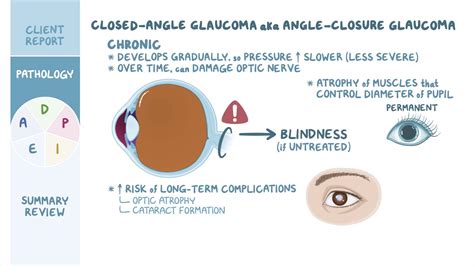 Acute Closed Angle Glaucoma