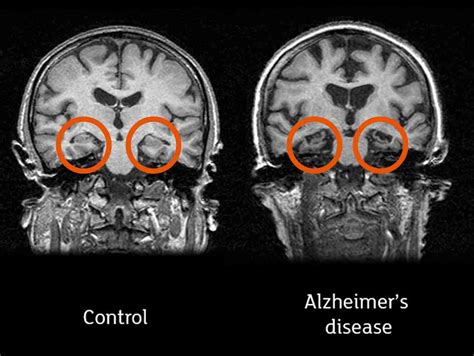 All you need to know about brain scans and dementia - Alzheimer's Research UK