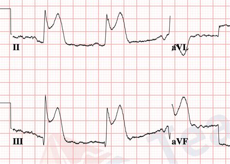 Ekg Practice Strips Printable With Answers | TUTORE.ORG - Master of ...