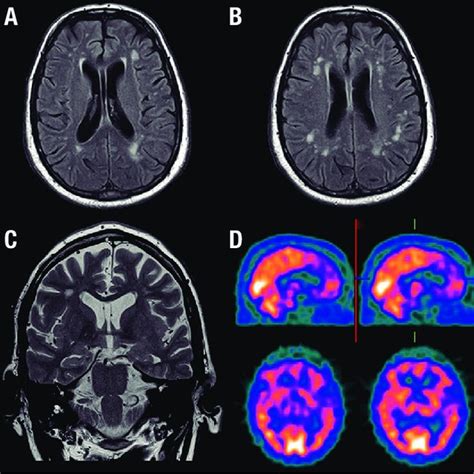 Flair MRI: Hyperintensity on deep white matter axial scans [A and B]... | Download Scientific ...