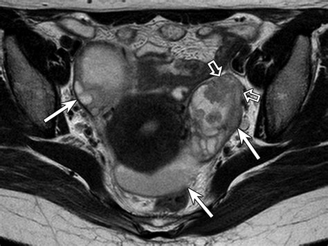 MR Imaging Findings of Hydrosalpinx: A Comprehensive Review | RadioGraphics