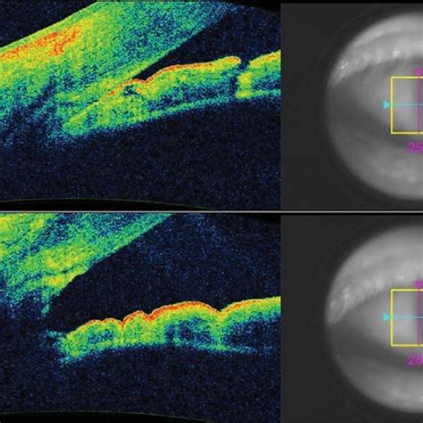 Left eye nasal iridocorneal angle anterior segment OCT images of the ...