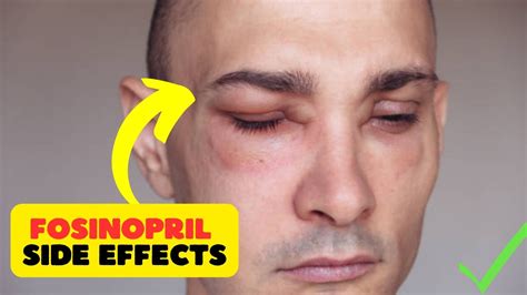 Fosinopril Side Effects: Understanding the Potential Risks and Safeguarding Your Health - YouTube