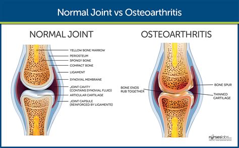 Osteoarthritis Nursing Care and Management: Study Guide for Nurses