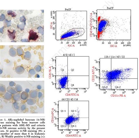 Table 2 from Acute monocytic leukemia diagnosed by flow cytometry includes acute myeloid ...