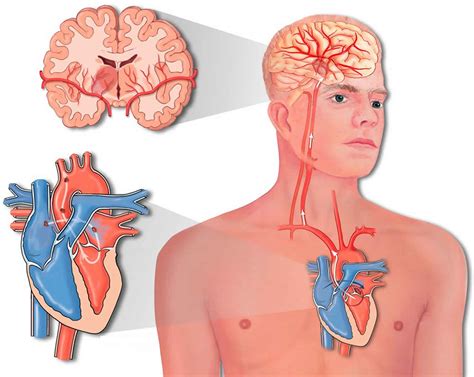 Paradoxical embolism causes, symptoms, diagnosis & treatment