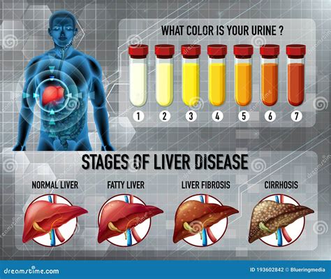 Liver Disease Stages