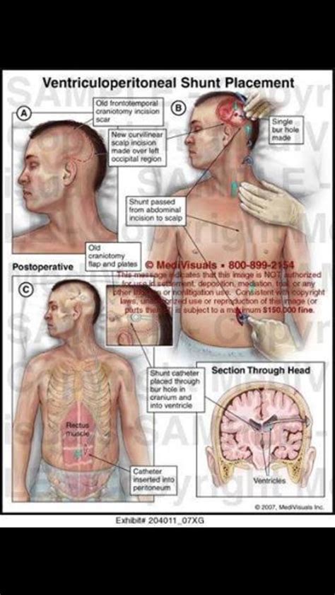 Pin on Idiopathic Intracranial Hypertension