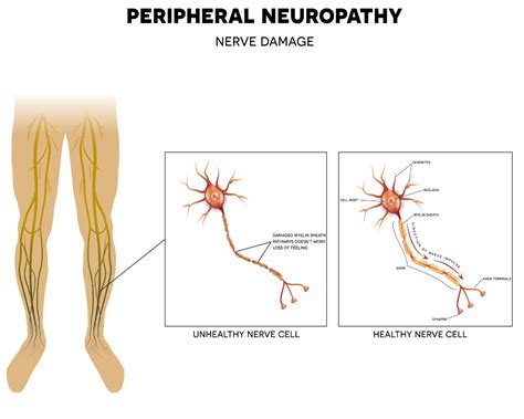 Small Fiber Neuropathy Causes and Treatment - Suzy Cohen, RPh offers natural remedies to help ...