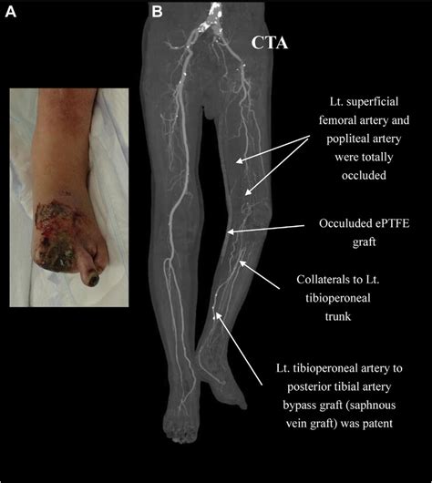 A, Preoperative photograph of the left foot showing that the first,... | Download Scientific Diagram