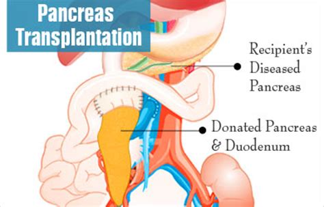 Pancreas Transplantation - Procedure, Evaluation, Preparation, Surgery, After care