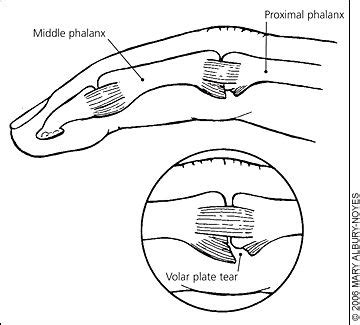 volar plate http://handtherapy.com.au/volar-plate/ | Finger injury ...