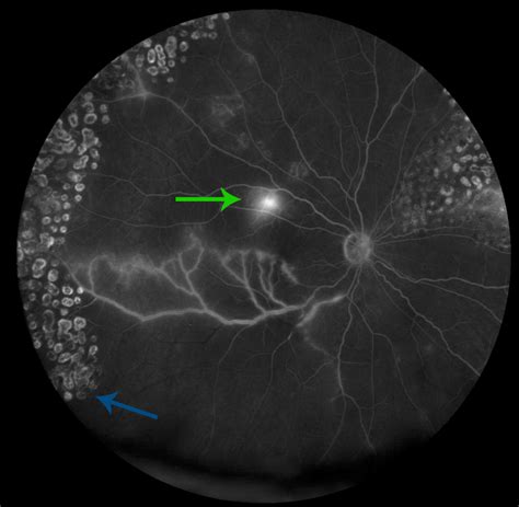 Moran CORE | Retinal Vasculitis