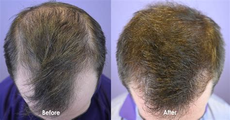 Low Dose Minoxidil Pill Prescribed For Early Hair Loss - Hair Restoration of the South