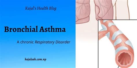 Bronchial Asthma| Definition | Classification | Pathophysiology| Investigation | Management ...