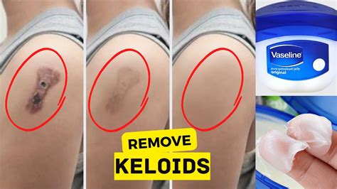 3 Effective remedies to remove keloid scars naturally | Home Remedies for Keloids - YouTube